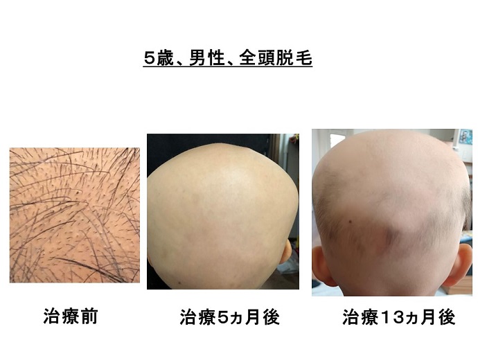 汎発性脱毛　病院